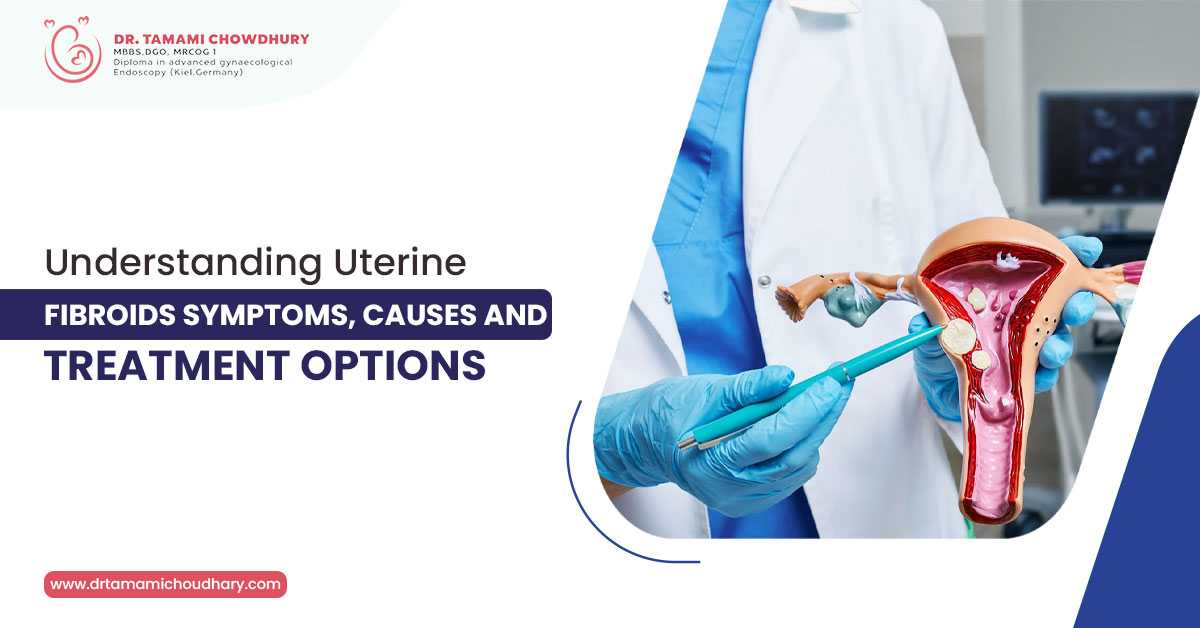 Understanding Uterine Fibroids: Symptoms, Causes, and Treatment Options